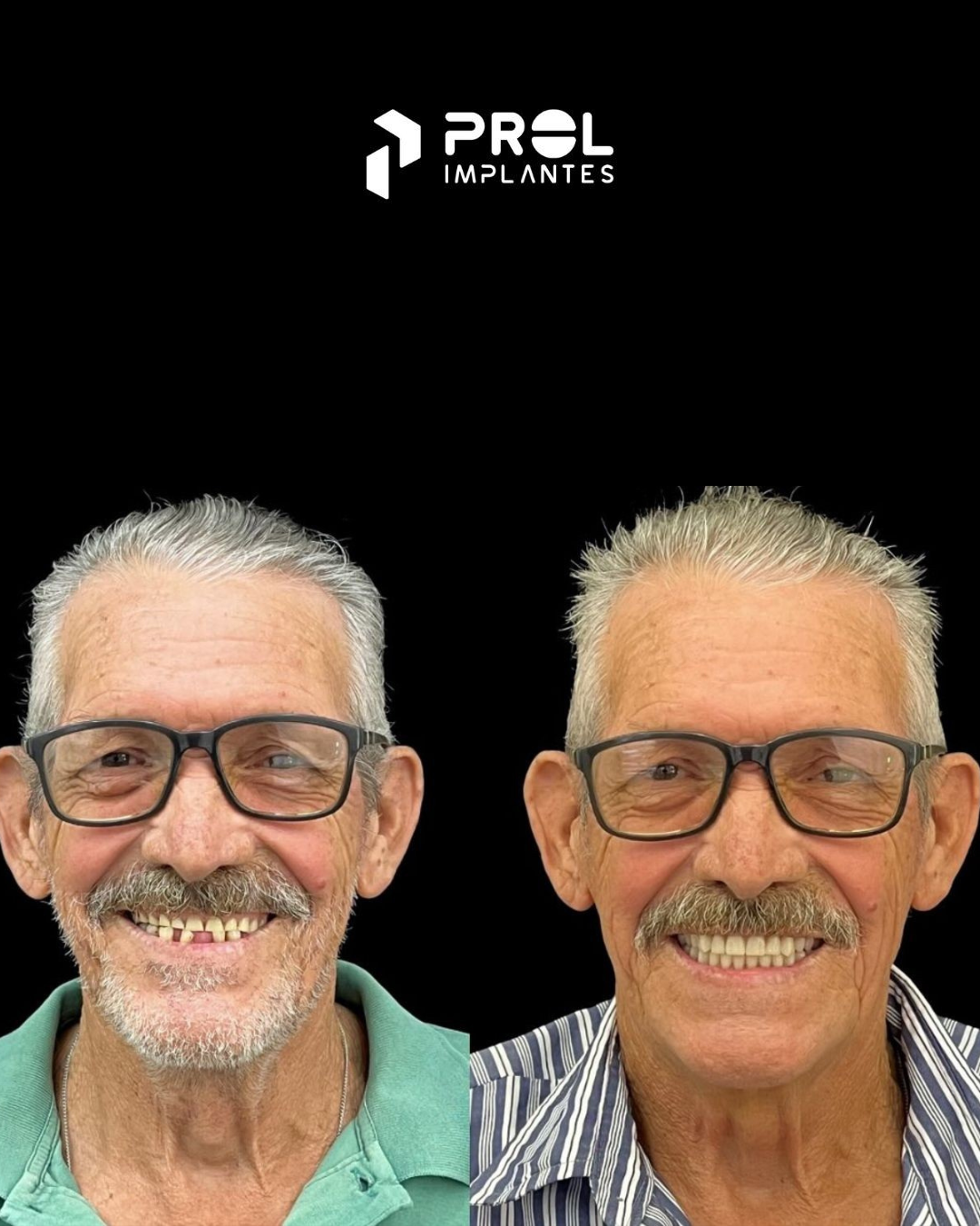 Prol Implantes - Antes e Depois 3