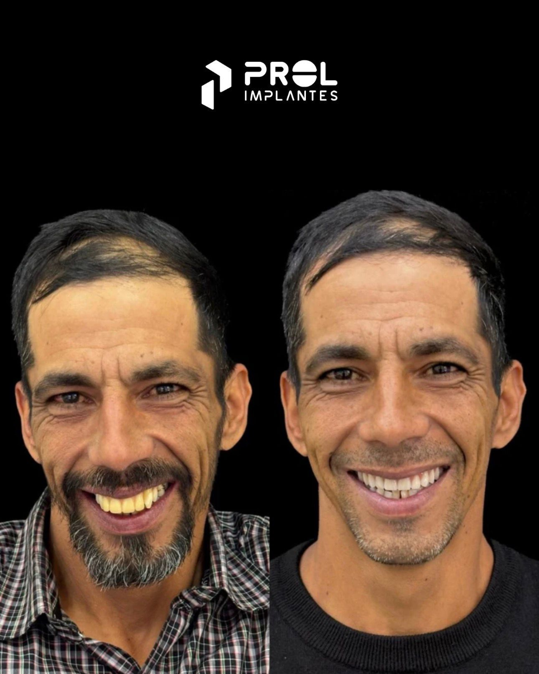 Prol Implantes - Antes e Depois 4