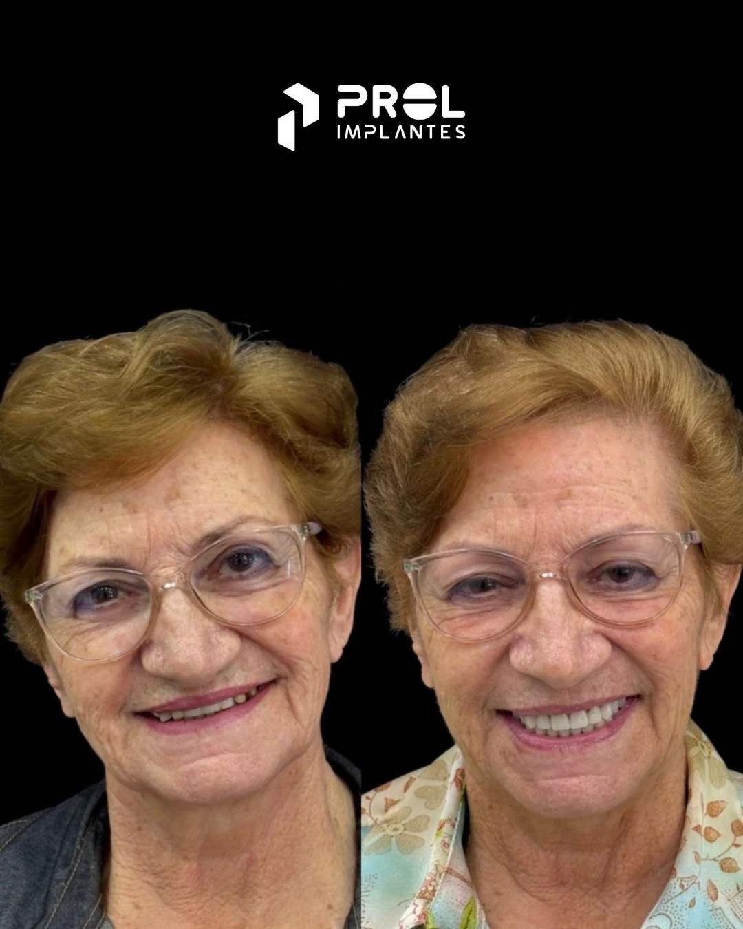 Prol Implantes - Antes e Depois 5