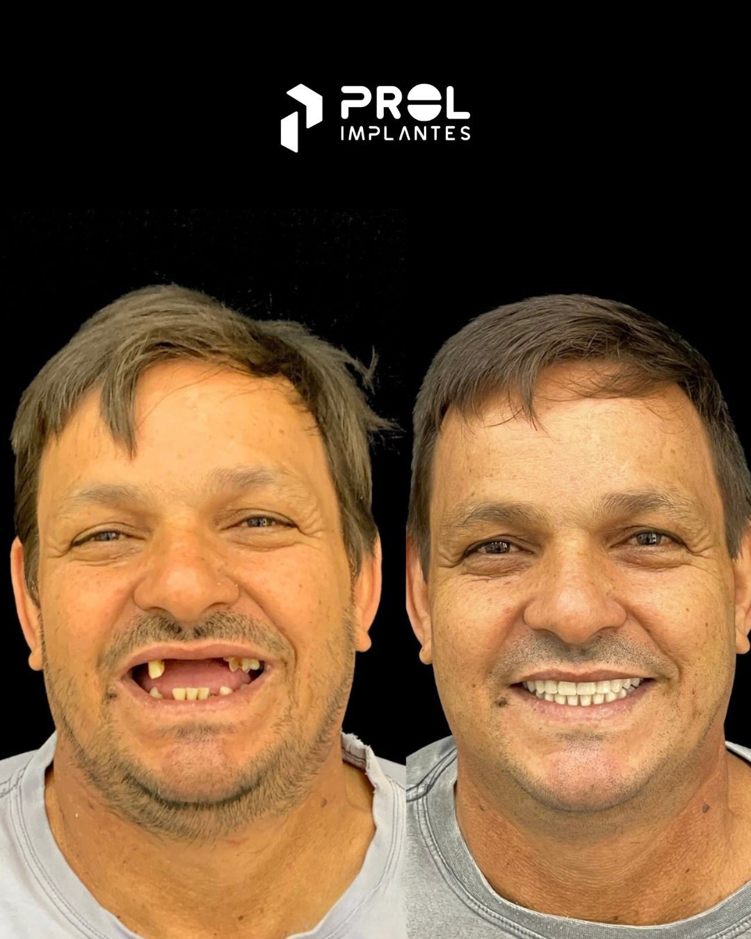 Prol Implantes - Antes e Depois